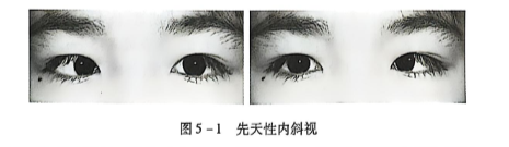 5-1先天性内斜视.PNG