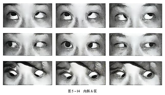 5-14内斜A征.PNG