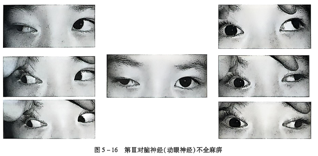 5-16 第Ⅲ对脑神经(动眼神经)不全麻痹.PNG
