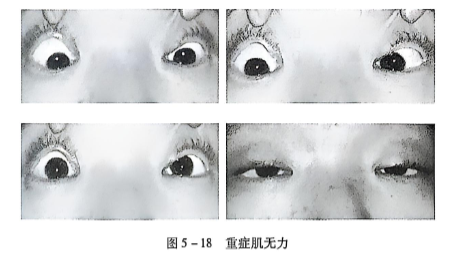 5-18 重症肌无力.PNG