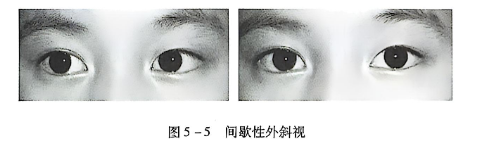 5-5间歇性外斜视.PNG