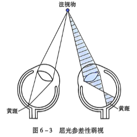 6-3屈光参差性弱视.PNG