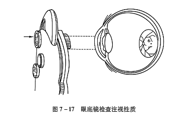 7-17 眼底镜检查注视性质.PNG